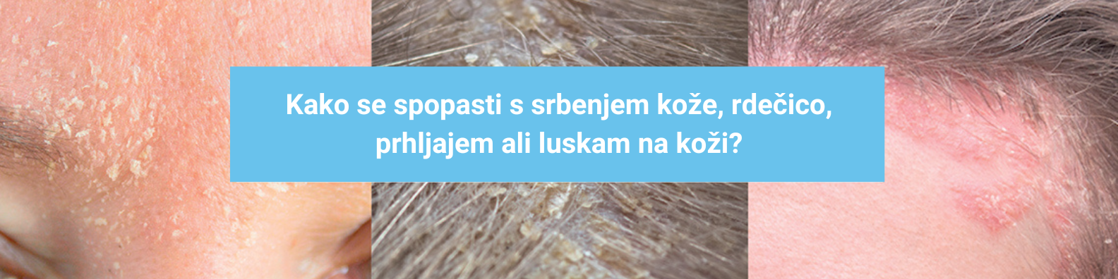 Fiderma seboroični dermatitis-1